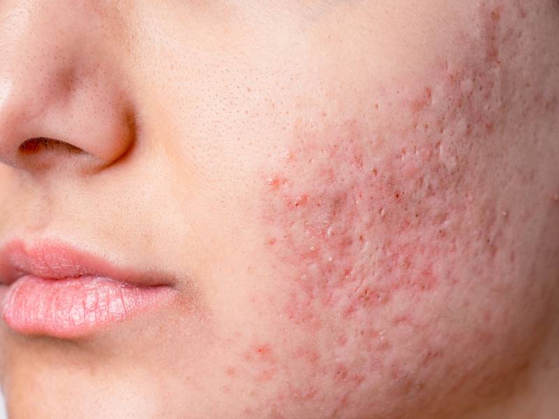 Acne & Acne Scars