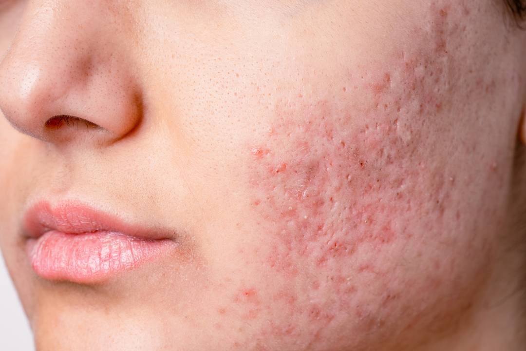 Acne & Acne Scars Banner