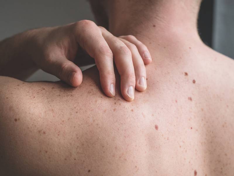 Skin Cancer Treatment