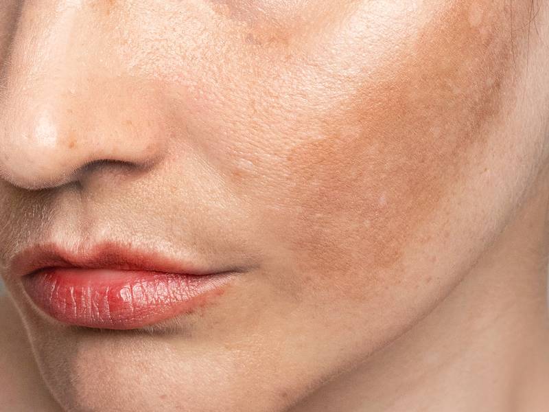 Pigmentation & Sun Damage