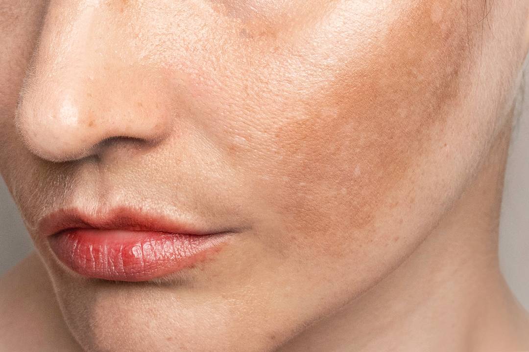 Pigmentation & Sun Damage Banner