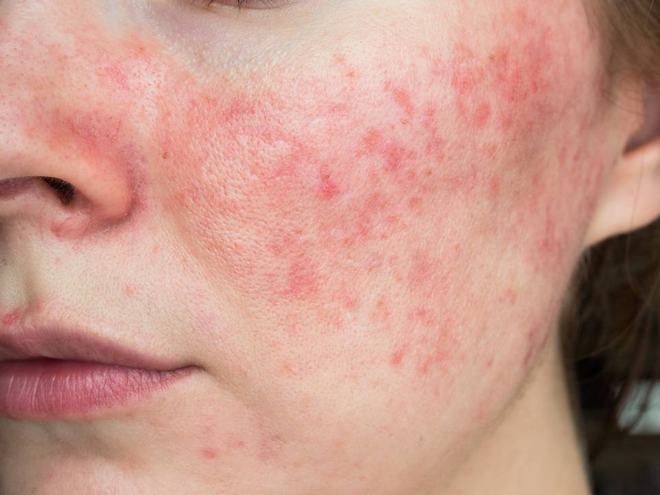 Rosacea & Facial Redness Banner